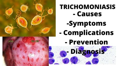 can trichomoniasis kill sperm